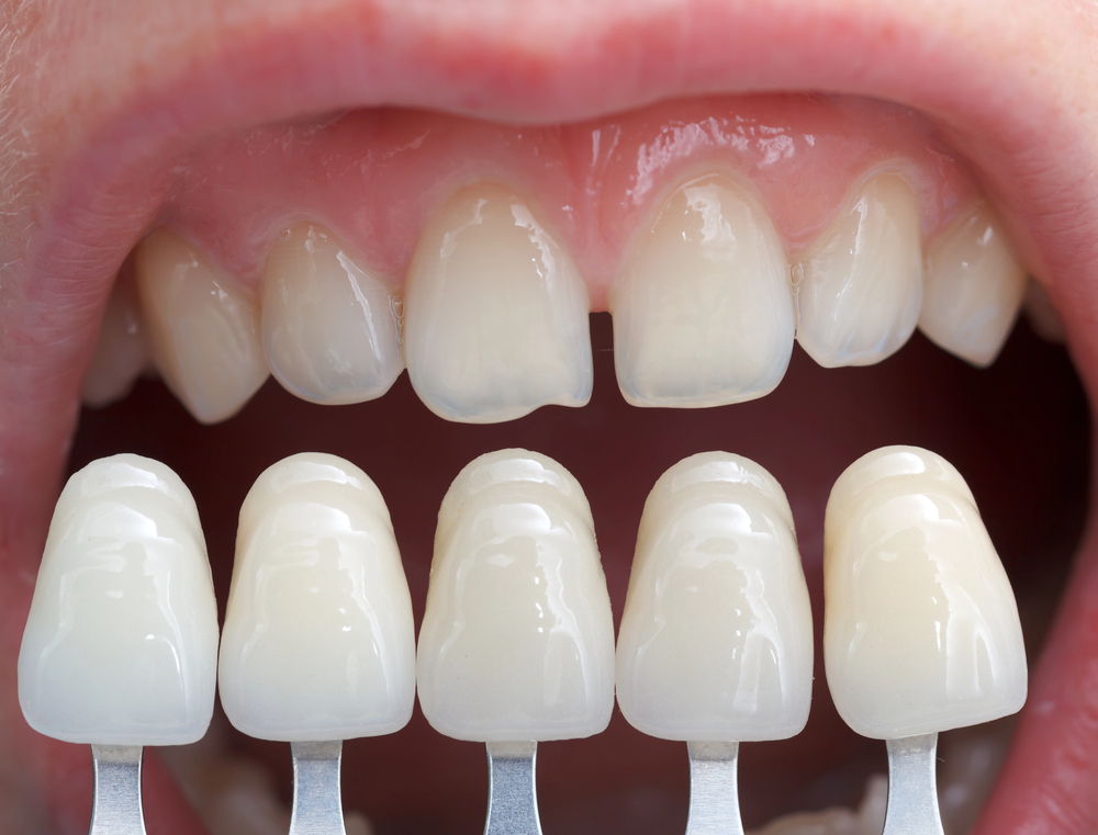 dental veneers process